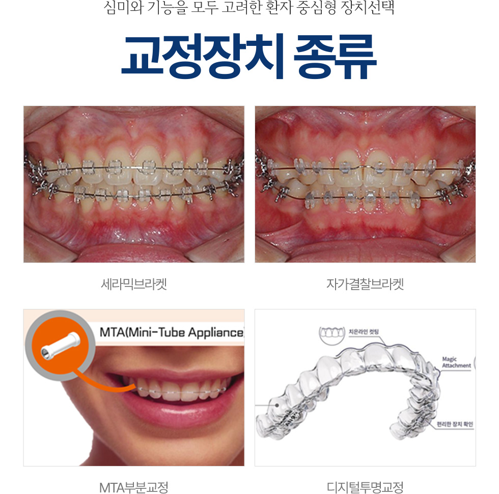 교정장치 종류